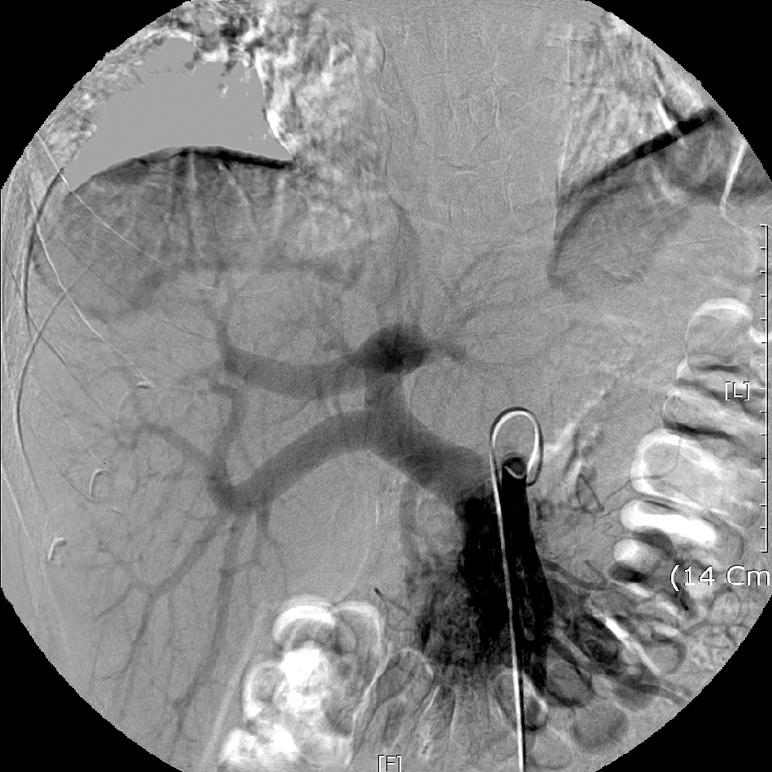 A contrast-enhanced abdominal computed tomography. It shows several dilated vasculatures around the portal vein in the pancreatic head portion. Figure 3. Celiac arteriography.