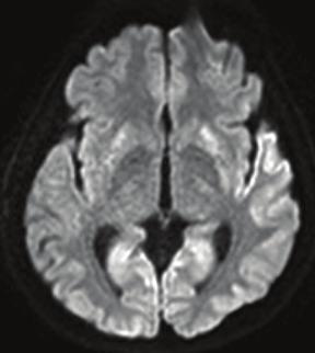 김동현외 : Heidenhain 변형 CJD 1 예 Figure 3. Increased signal intensity in bilateral caudate lobes, putamina and the cortex of the occipital lobes on diffusionweighted brain MRI. 0.7 이었고, 시신경유두의창백은관찰되지않았다.