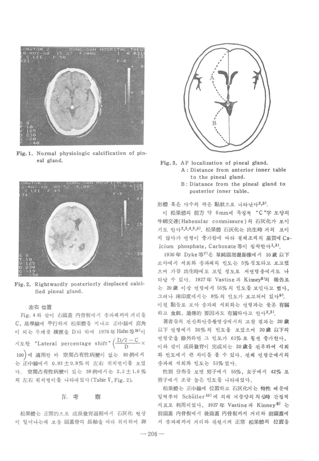 Fig. 1. Normal physiologic calcification of pineal gland. Fig.3. AP localization of pineal gland. A: Distance from anterior inner table to the pineal gland.