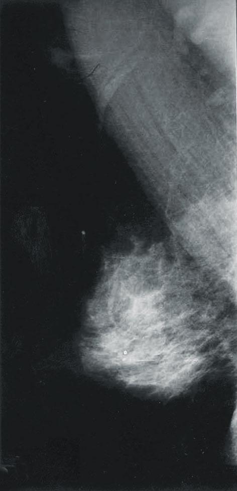 Impression; No evidence of malignancy. B. 2003 July: About 1cm sized relatively well marginated nodule is seen on right upper outer area, axillary tail.