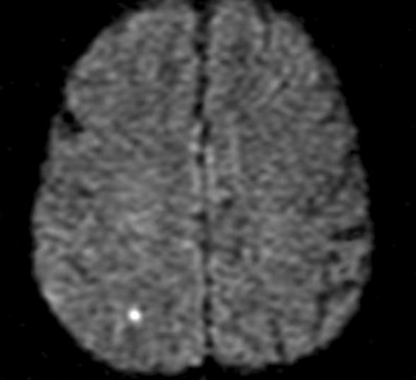 메타분석에서 결과의 불신으로 이어지기도 한다. 과거 옥스포드 지역 24%에서 과거 뇌경색의 흔적이 보였다.