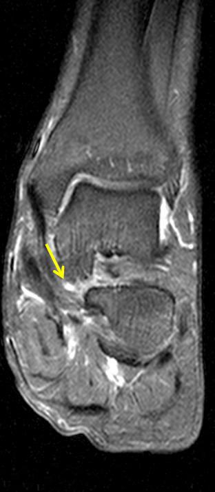 (A) Coronal T1 (TR=615/12 ms) image show medial plantar nerve articular branch to subtalar joint