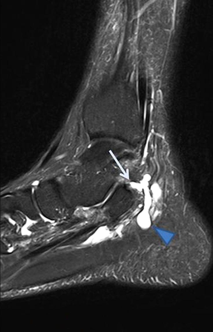 (B) Sagittal T2 (TR=4970/97 ms) image show lateral plantar nerve intraneural ganglion (arrowhead) and articular branch