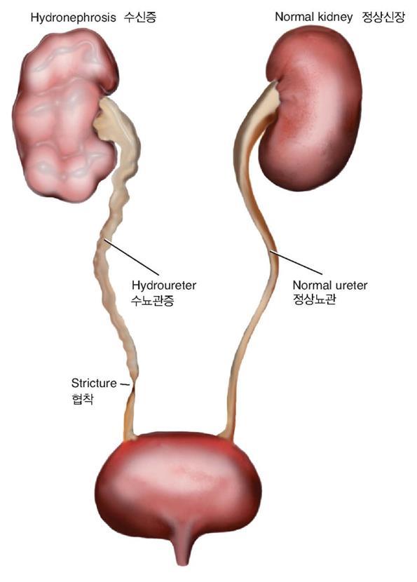 2) Urinary Obstruction( 요폐쇄 )
