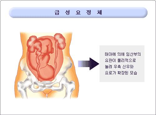 3) Urinary Obstruction( 요폐쇄 ) 소변정체, 요정체 (urinary retention) 원인 : 내인성질환 : -