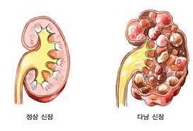5) 선천성이상 polycystic kidney disease(pckd)