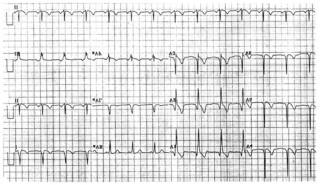 Fig. 2. Surface ECG of a patient with right posterior accessory pathway. Table 4. Frequency of atrial fibrillation and multiple bypass tracts in ART and ORT patients ART ORT P-value A-Fib 5/1827.