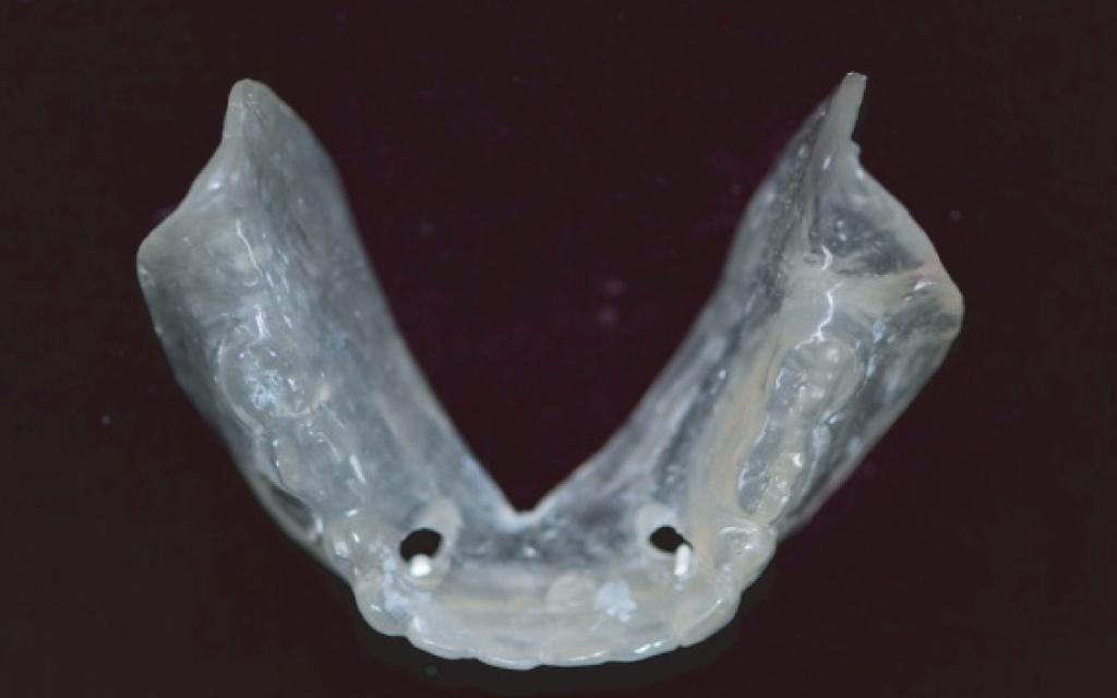 : Mandibular Implant-Overdenture Prosthesis Using the Self Fig. 5. Magnet attachments were connected with implant fixture.