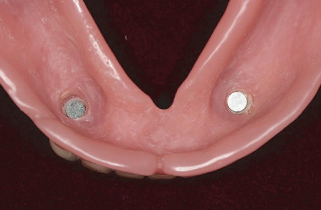 Rubber dam blocked-out the acrylic resin that connected magnet abutment and mandibular prosthesis. 서장착하는것이중요하다.