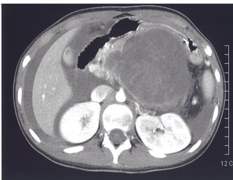 윤혁진외 : 소아에서의췌장의고형유두상상피성종양 33 Table 1. Demographics, Clinical Presentation and Diagnosis of Children with SPEN* Case No.