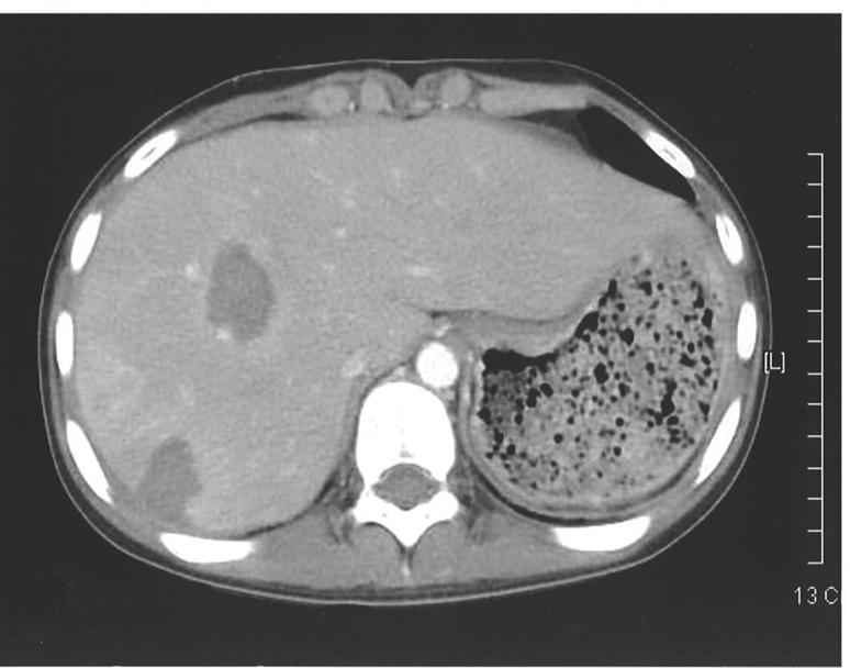 술후 ifosfamide, etoposide, cisplatin 을이용하여 3차례의항암요법을시행하였으며복부전산화단층촬영상종양의크기가 7.5 cm로줄어들어서 ( 그림 3) 1차수술 3개월후다시 2차수술로췌장아전절제술및비장절제술을시행하였다.