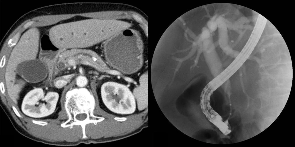Emergency angiography demonstrated pseudoaneurysm of the splenic artery (B). After embolization with coils and glue (C), no contrast leakage is seen (D). B D.,.,,.. A B Fig. 4.