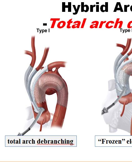 Session IV TEVAR Live 2 and Hot Issues 또다른분류법으로는 Szeto 등 5) 이주장한방법으로치환된수술의부위에따라분류하는방법도있다 (Fig. 4) Figure 4. Classification of hybrid aortic arch repair by Szeto WY.