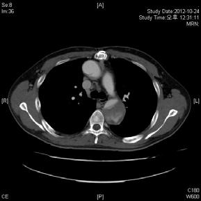 2 nd Gangnam Severance Hybrid Aortic Surgery 2014 Case 5. Hybrid TEVAR for residual CTBAD following Acute type A aortic dissection repair Ryu Sang-Wan, M.D. 1, Kim Kwan-Sik, M.