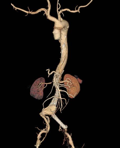 CAOD (3VD) 로 PTCA 시행받은과거력있는환자로내원 1시간전 Rt, knee-foot pain을주소로 ER 내원하였다. Lower extrimites CT angio 상 Rt popliteal artery 에 acute embolism 및 infrarenal AAA 87mm 발견되어입원하였다.