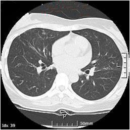 (C) Chest CT scan 3 months after admission. Parenchymal consolidation in the right upper lobes and middle lobes had decreased. Table 1.