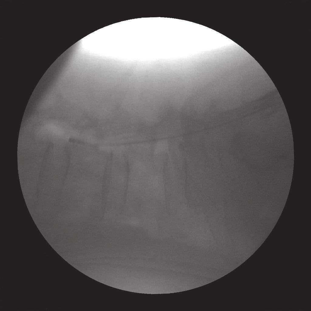 Trochar was inserted into the epidural space through sacral hiatus. Fig. 2.