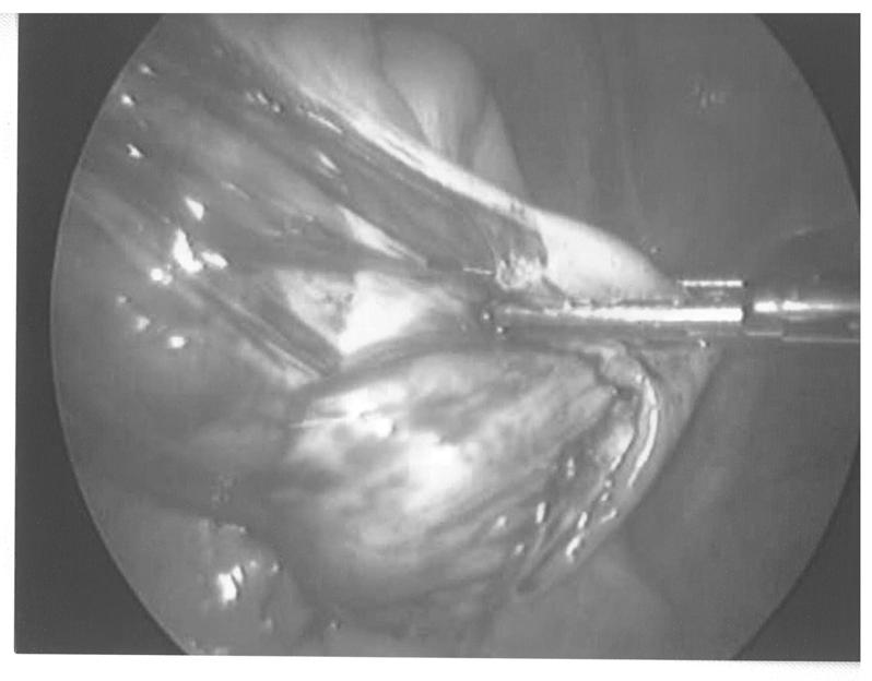 42 소아외과 제 12 권 제 1 호 2006년 Fig. 1. Abdominal CT of the first case, showing a thin walled septated cystic mass, measuring 7cm in diameter, with calcification and fat in pelvic cavity.