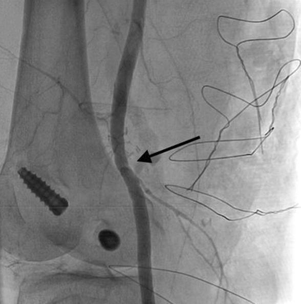 이길수 외 슬와동맥 손상 Fig. 1. (A) Angiography showed abrupt occlusion and extravasated dye material of right popliteal artery (arrow). (B) Post operative angiogram. Fig. 2.