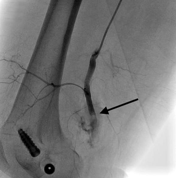 (B) Post operative patent popliteal artery was noted in the computed tomographic angiography (arrow). 골 신경을 확인 하였다. 그러나 정상적으로 경골신경의 다(Fig. 1B).