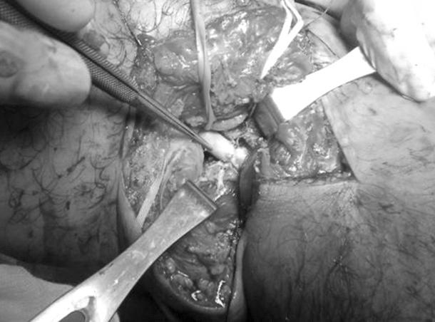 대흉외지 2008;41:772-776 Fig. 3. (A) Preoperative photographic finding of right popliteal area. (B) Injured right popliteal artery (arrow).