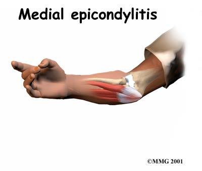 Medial Epicondylitis Golfer s elbow Medial epicondyle 에서기시하는