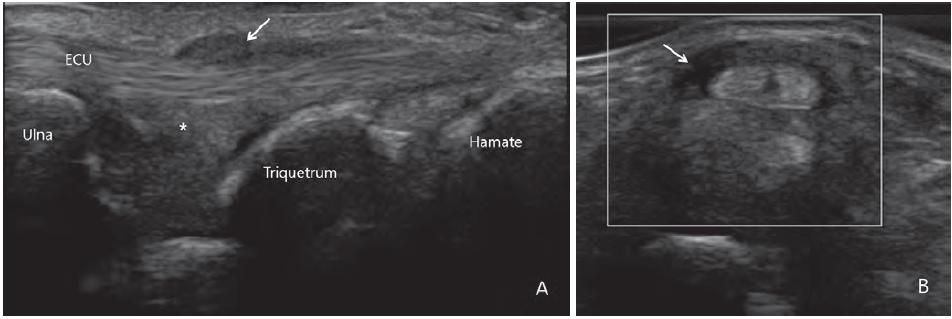 Extensor Carpi Ulnaris Tenosynovitis Ulna에대한이힘줄의반복적인마찰에의해서발생 손목신전근의 6번째구획 (compartment) 인