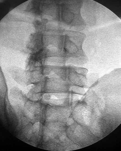 Lumbar facet joint block Prone position Infiltration the entry
