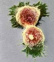 암발병인자 (2) 성호르몬 난포호르몬과다분비 : 자궁암, 유방암 정신적인스트레스 시상하부에서코티솔과다분비
