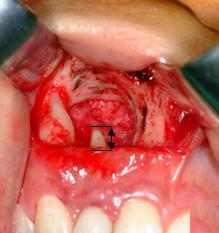 하나는치근단부위에발생한치근단치근낭 (periapical cyst, apical periodontal cyst) 이며, 다른하나는큰보조치수관 (accessary pulp canal) 로부터치수염증이파급되어치근의측면에염증성낭을형성한측방치근낭 [lateral radicular (periapical) cyst] 이다.