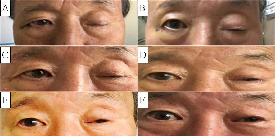 우성진 백경민 장우석 Fig. 2. Photograph of patients s Blepharoptosis on foward gaze.
