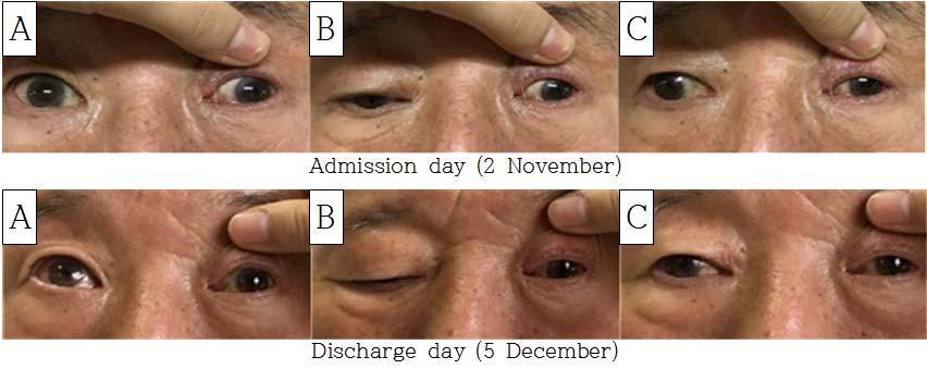 November, F : 5 December Fig. 4. The change of ocular motility disorders.