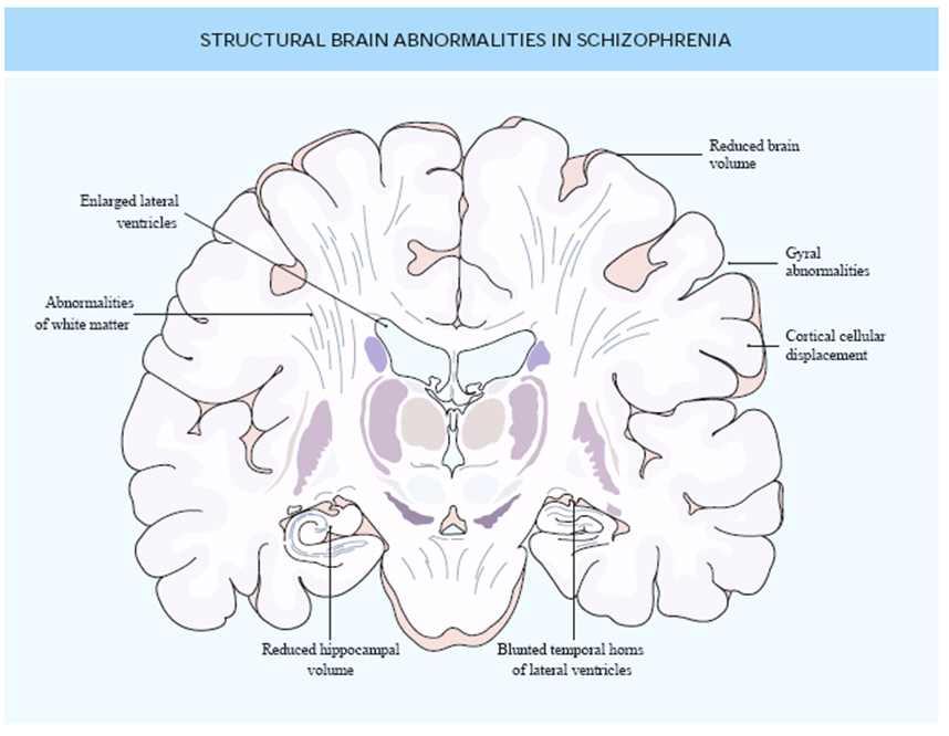 뇌신경회로연구에서전대상회 - 기저핵 - 시상 - 피질회로 (anterior cingulate-basal gangl ia-rhalamo-corticla circuit) 의이상은양성증상, 배외측전전두피질회로 (dorsolateral prefrontal circuit) 의이상은음성증상과관련가능성을시사 4) 신경생리학적요인 Electrophysiology EEG