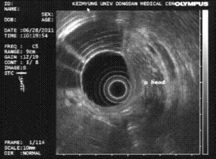 In Wook Song, et al Fig. 3. Endoscopic ultrasonogram shows no definite mass lesion in pancreas. Table 2.
