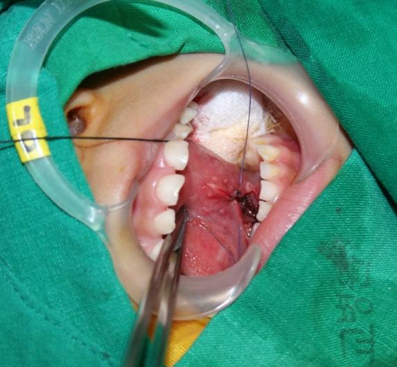 The patient is asked to open his or her mouth as wide as he or she can and touch the edge of the upper teeth with tongue.