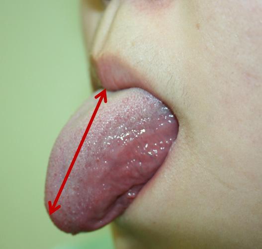 The patient is asked to protrude his or her tongue as long as he or she can.