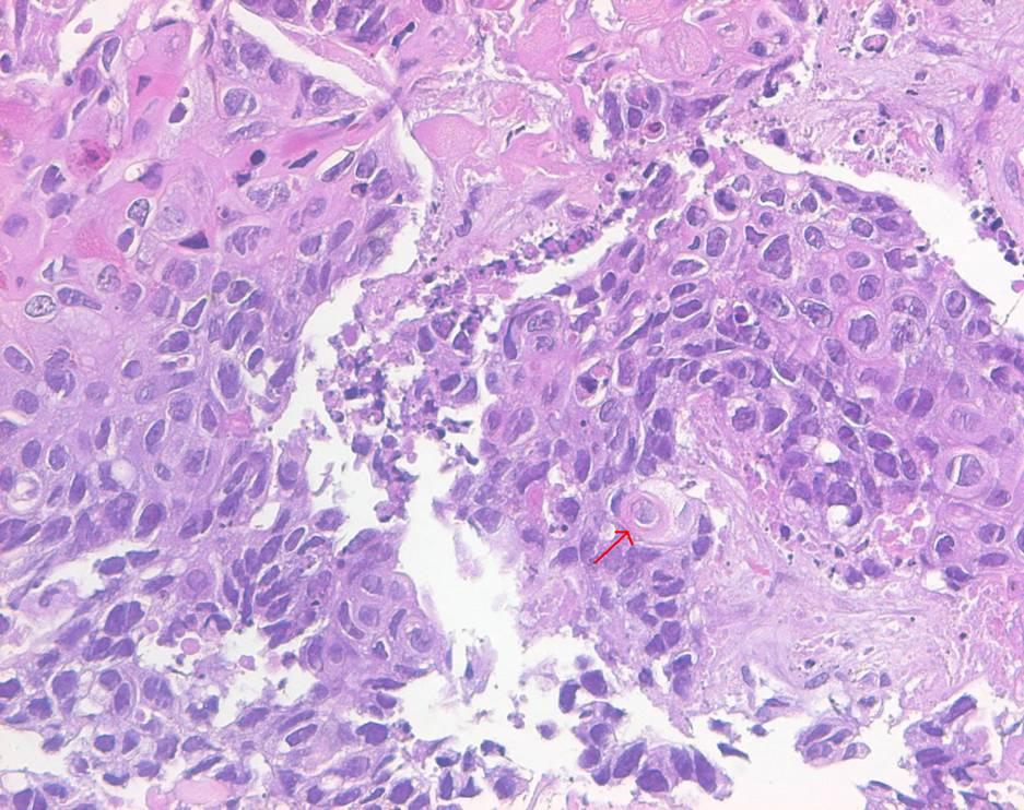 - Yoon Hee Chun, et al. Primary squamous cell carcinoma of the pancreas responding to chemotherapy - A B Figure 2. (A) Microscopic view of pancreatic mass (H&E, 400).