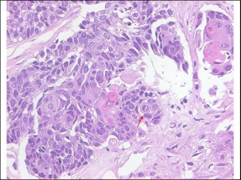 The arrow shows an intercellular bridge, which is characteristic of squamous cell carcinoma.