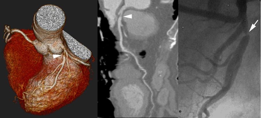 - Chan Joo Lee, et al. Normal coronary CT angiography with subsequent adverse cardiac events - slice collimation, 1 mm slice width, and 3.