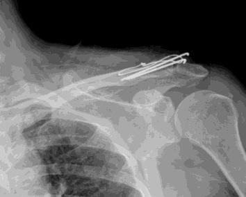 (C) Roentgenogram after removal of wires at postoperative 9 months.