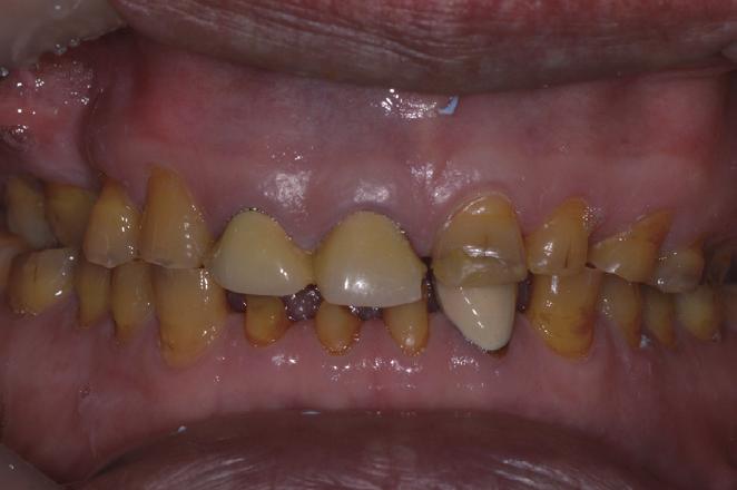 Full mouth rehabilitation on the patient with severe tooth wear and tooth fracture using reestabilishment