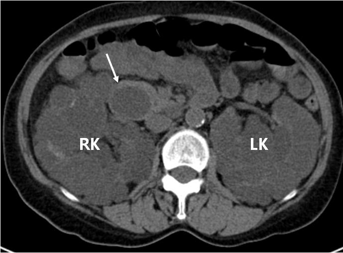 - The Korean Journal of Medicine: Vol. 85, No. 2, 2013 - 성에대한보고가없었으나최근 ADPKD에서 Caroli 병이발견되고간외담관낭종이수예보고되면서 ARPKD 뿐만아니라 ADPKD와담관낭종과의관련가능성이제기되었다 [3]. 현재까지국내에서는 ADPKD 환자에서담관낭종이동반된증례는 1예만이보고되어있다 [4].