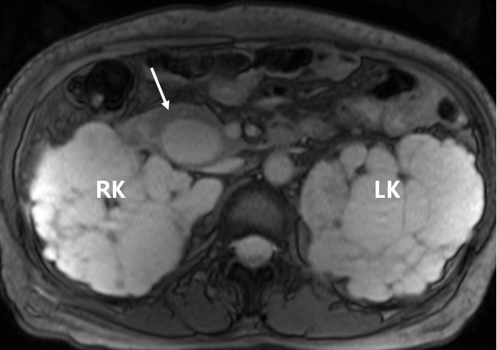 - Seung Jee Ryu, et al. ADPKD with type I choledochal cyst - A B Figure 2.