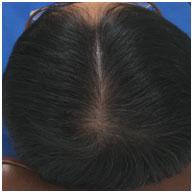고찰사람의머리카락은평균 10만에서 12만개정도로하루에 50~100개까지빠지는것은정상범위로보는데, 빠지는숫자는계절, 나이, 건강상태에따라차이가난다 10).