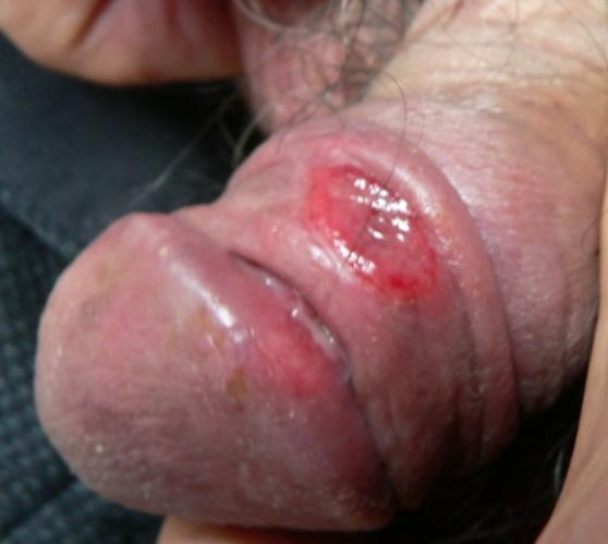 매독 (Syphilis) 병인 Treponema pallidum 병기임상소견임상사진 1 기 잠복기 : 3 주 (3~90 일 ) 경성하감 (chancre),