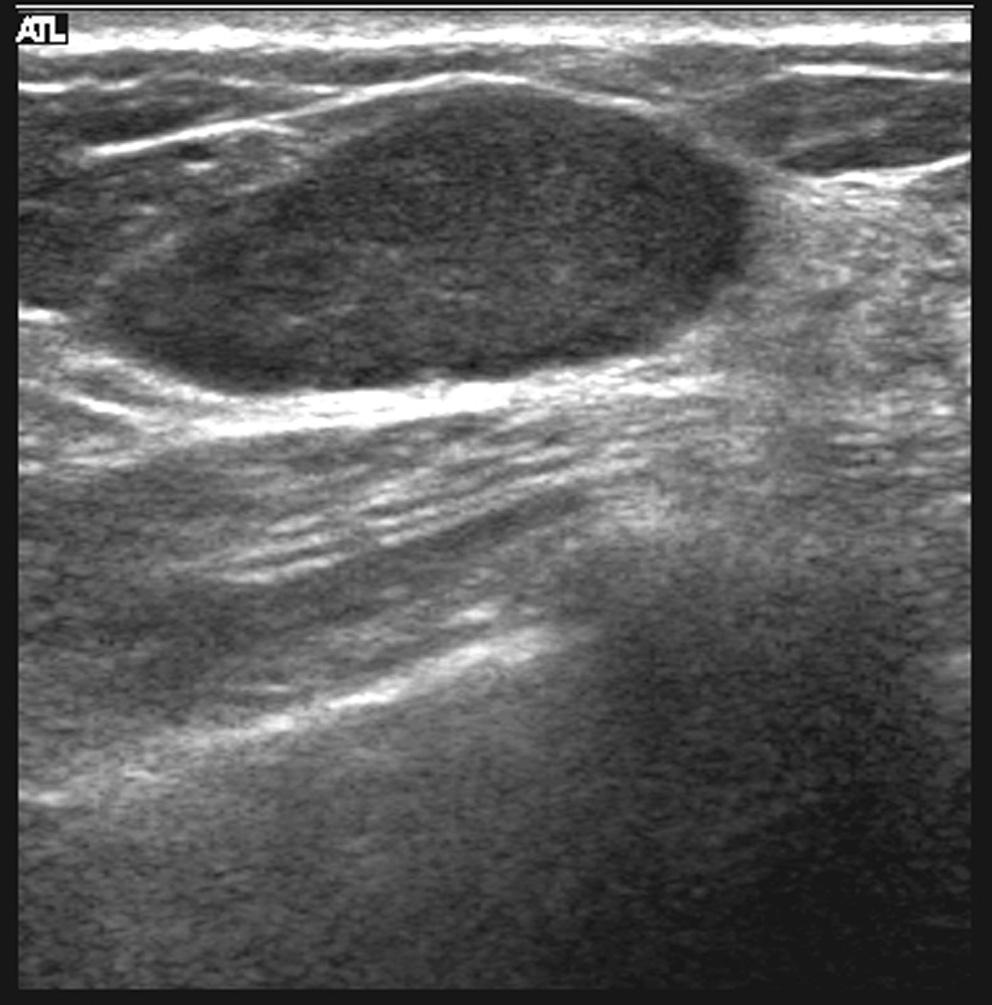 enhancement, suggesting a benign lesion. It was proven to be a benign phyllodes tumor in a 19year-old woman. Fig. 3.