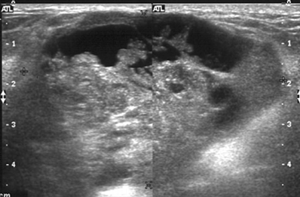 round shaped, indistinct margined (arrow) mass with posterior enhancement.