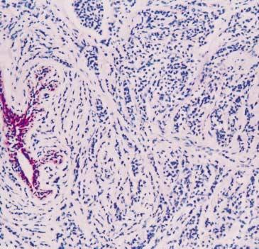 () However, E-cadherin immunostaining shows strong positivity in infiltrating ductal carcinoma.