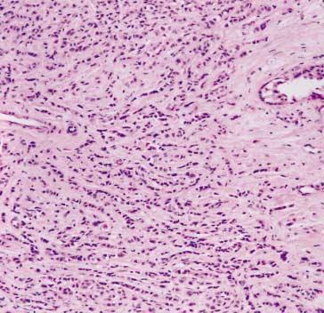 () The infiltrating lobular carcinoma is E-cadherin negative, where the residual normal ductal
