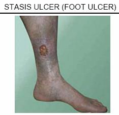 7 4. Venous Stasis Leg Ulcer A. 다리정맥의부족, 기능저하, 밸브이상, 감염, 영양실조등에기인한다. B. 주로 50세이상, 비만, 가족력, 비활동적생활스타일등을가진사람에게서발병한다. C. Ulcer 환자중 70% 를차지한다. D. 정맥혈류가막히면그부분에압력이발생하여부풀어오르기도한다.